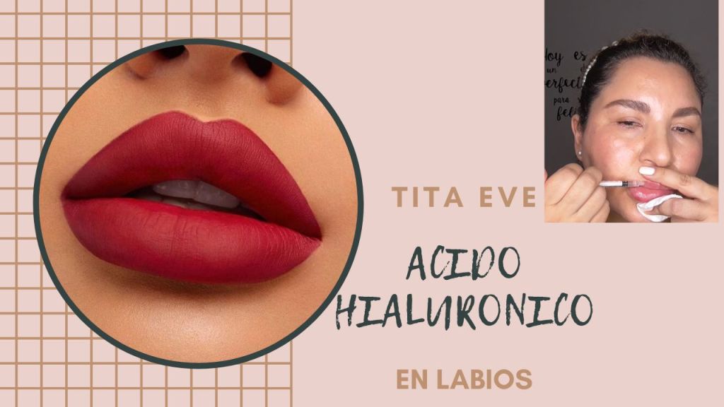 Cómo Inyectar Ácido Hialurónico en los Labios