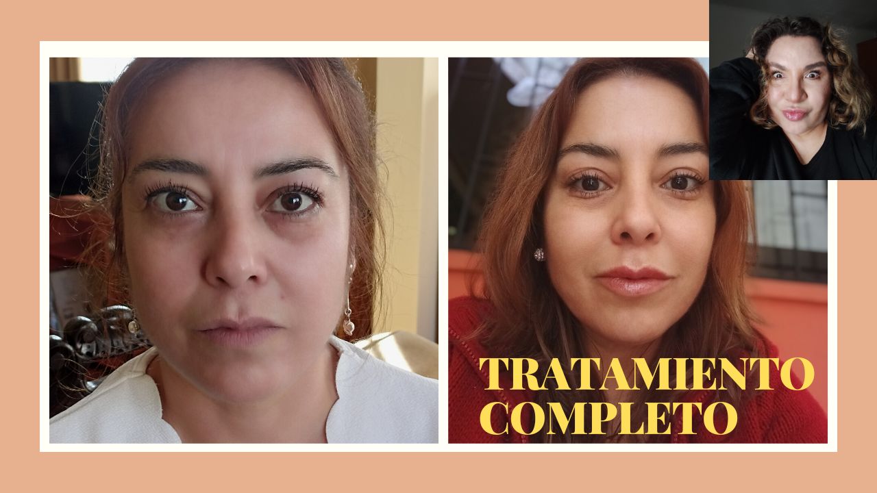 TRATAMIENTO NASOGENIANOS, LABIOS Y TOXINA BOTULINICA ( ANTIGUO )