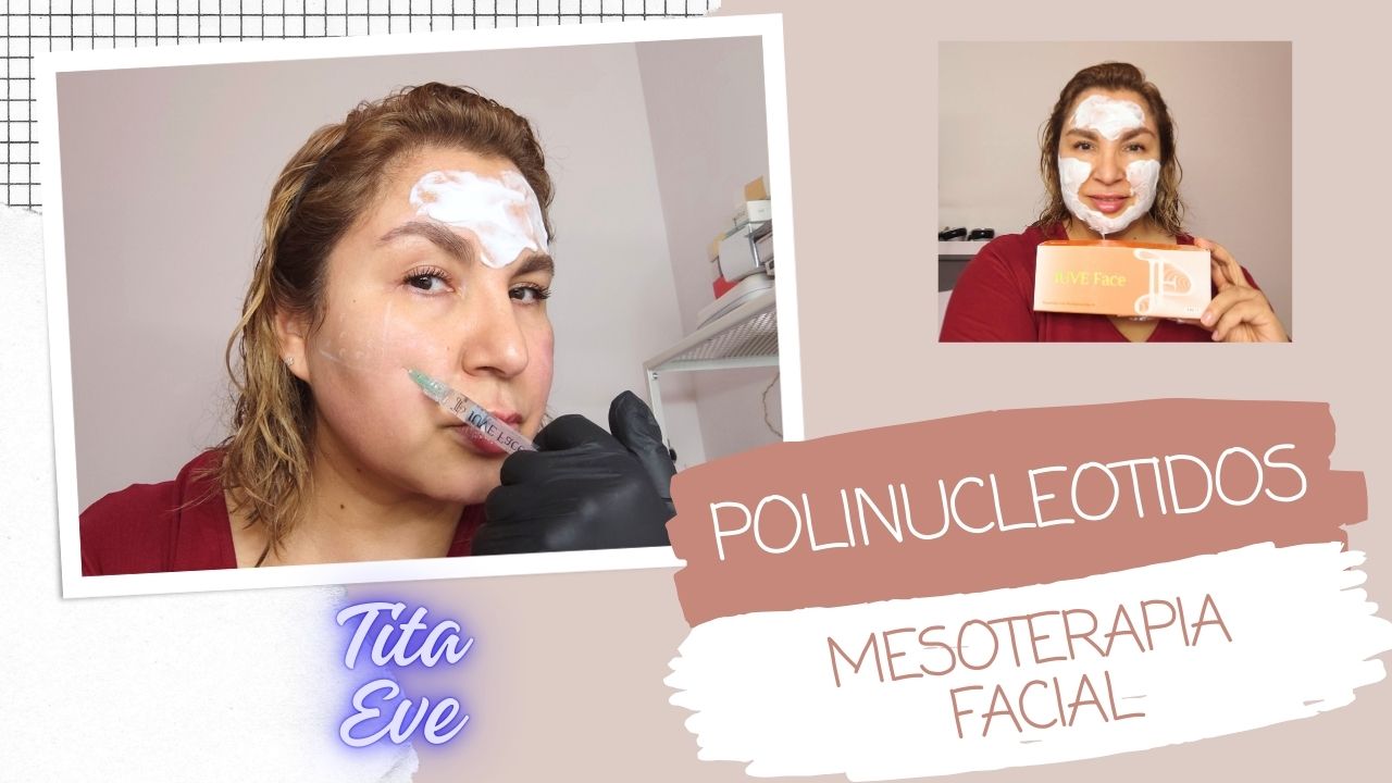 MESOTERAPIA CON POLINUCLEOTIDOS JUVE FACE , CARA REJUVENECIDA