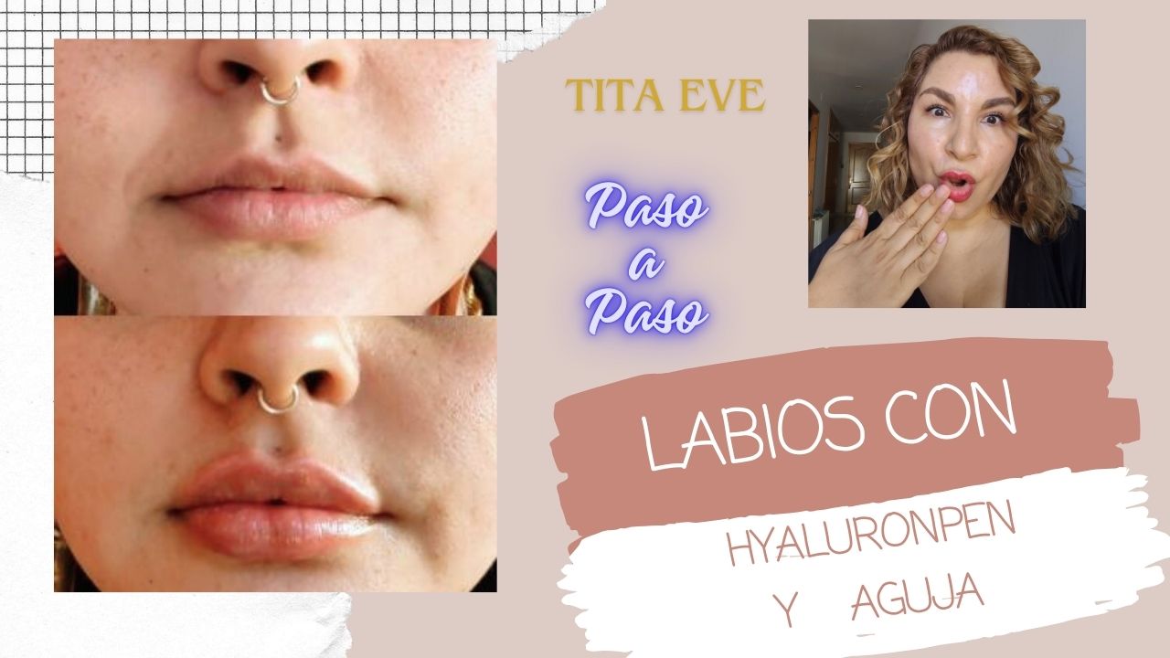 TECNICAS  AVANZADAS PARA LABIOS CON HYALURON PEN y AGUJA