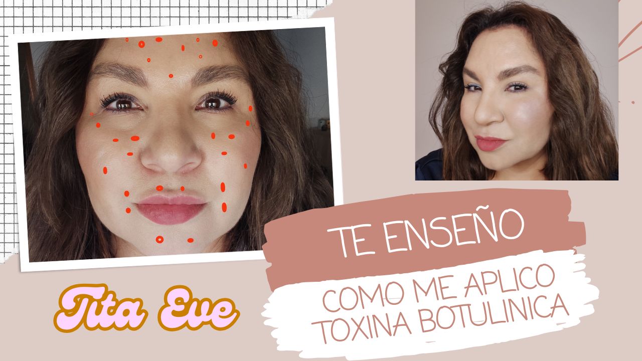 Aplicación de Toxina Botulínica: Guía Paso a Paso
