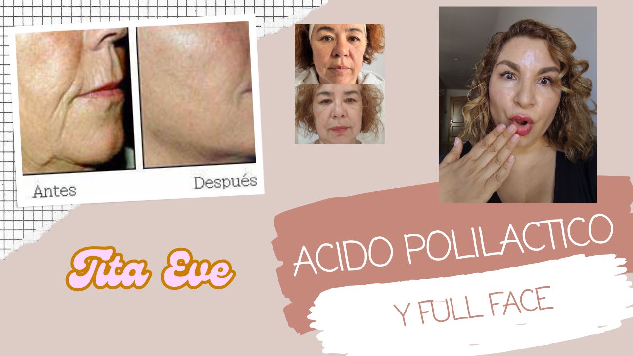 Mejora Facial: Acido Polilactico, Botox, Hilos Tensores y Acido Hialuronico