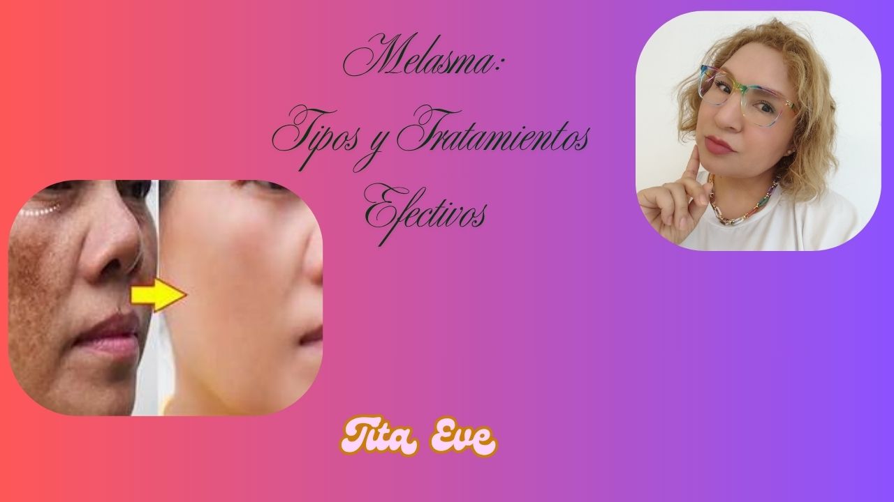 Melasma: Tipos y Tratamientos Efectivos