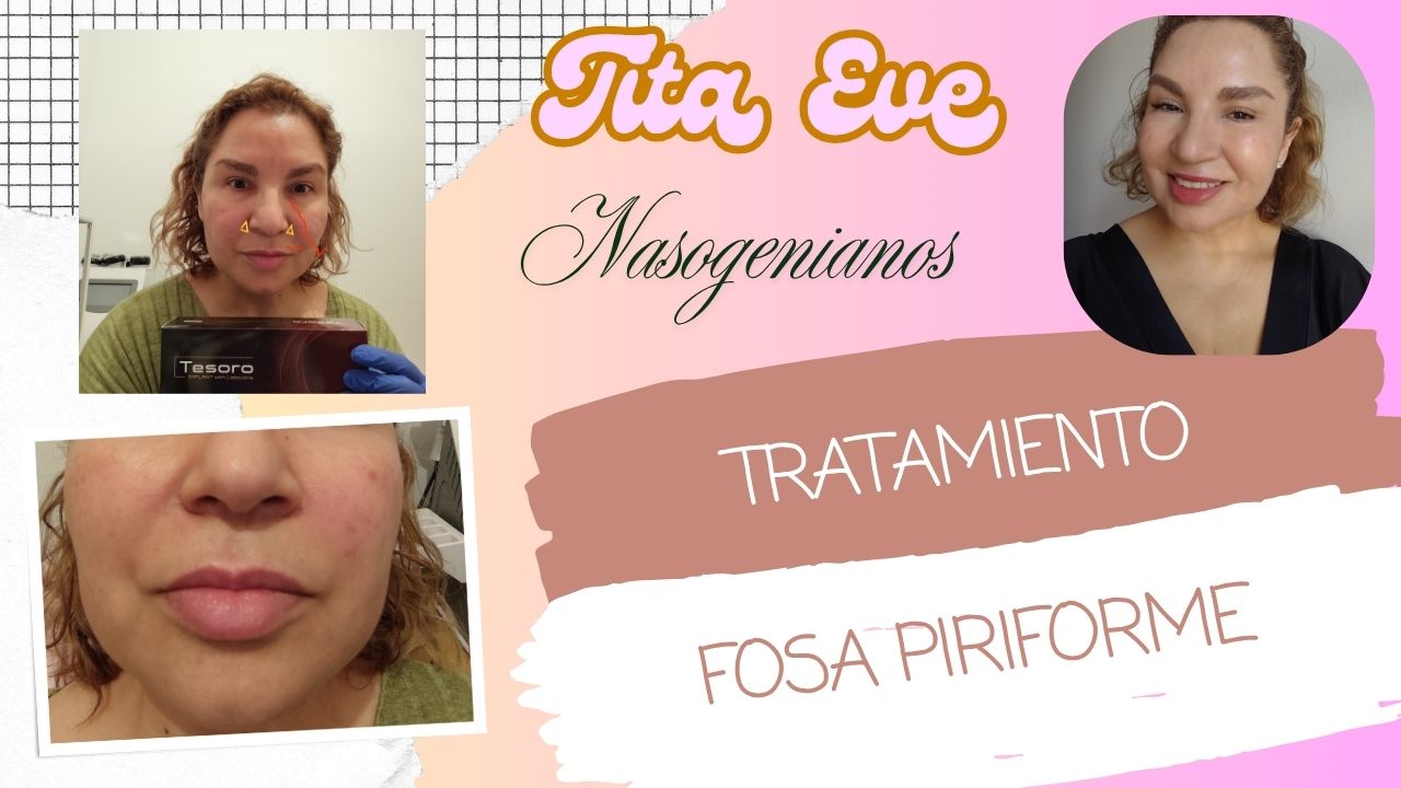 Corrige la Fosa Piriforme para un Rostro Juvenil